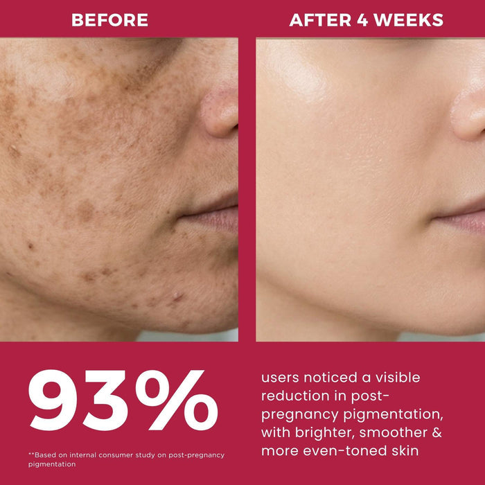 Post Pregnancy Skin Restore Regime – Pigmentation Repair Routine